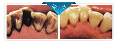 潔牙前后對比圖